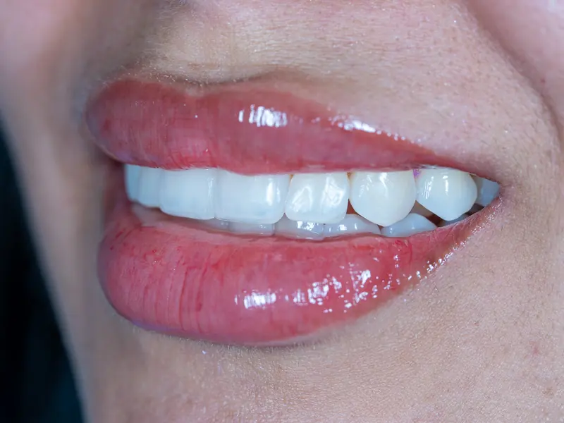 Detalle de los bordes incisales restaurados: contorno parejo y brillo natural