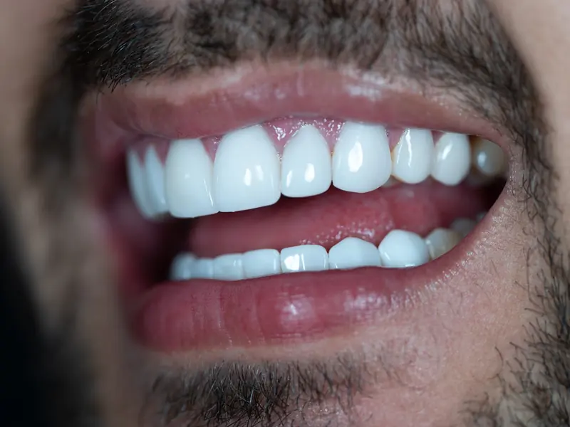 Detalle de dientes con lentes cerámicos: forma, proporción y brillo natural