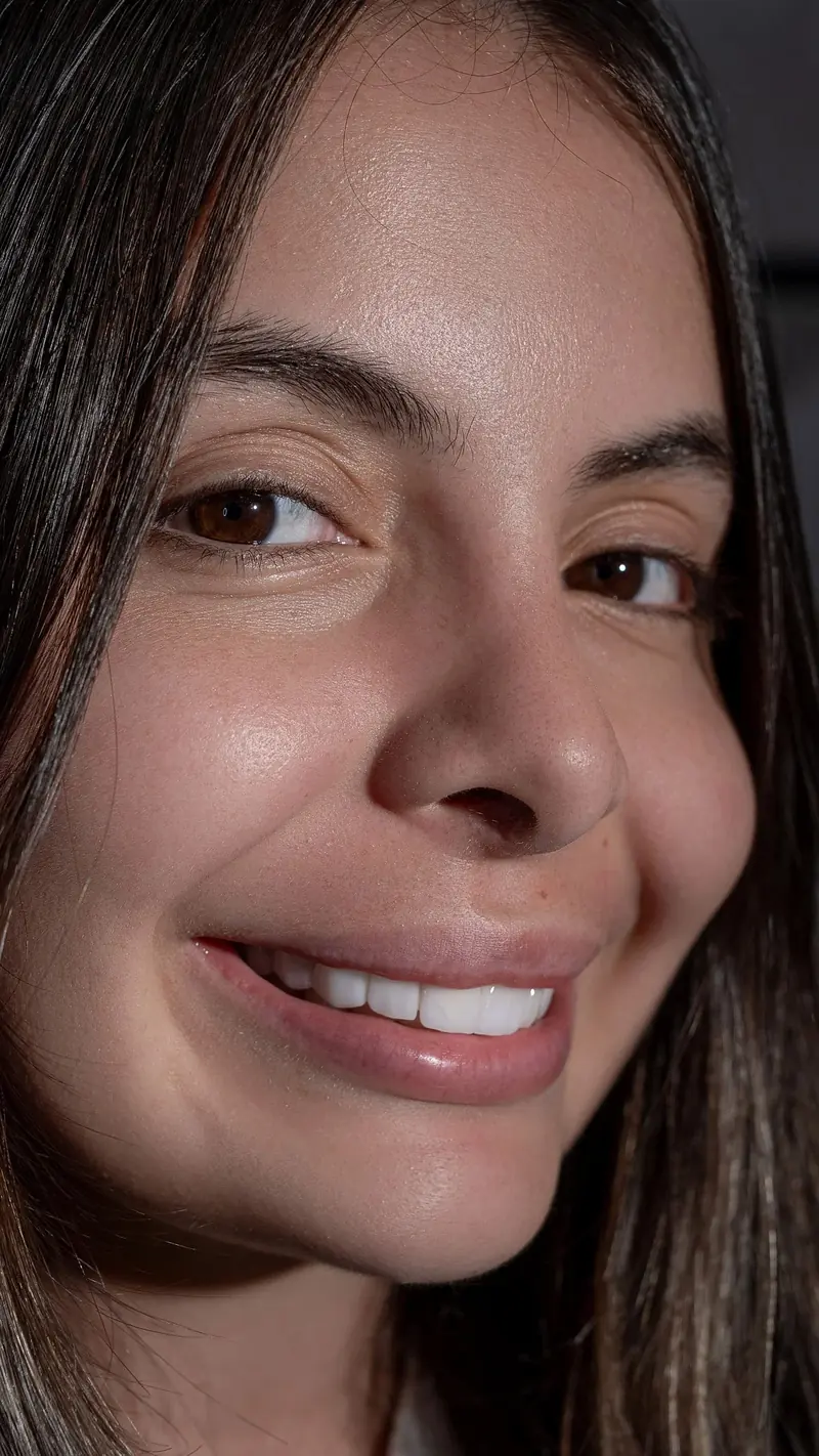 Paciente sonriendo con su diseño de sonrisa en lentes cerámicos en Villavicencio