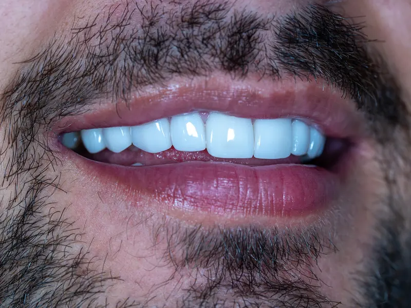 Primer plano de la sonrisa tras el diseño de sonrisa, con dientes alineados y brillo natural