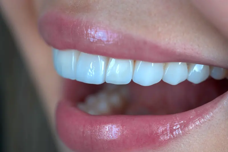 Primer plano de una sonrisa tras un diseño de sonrisa con lentes cerámicos en Villavicencio
