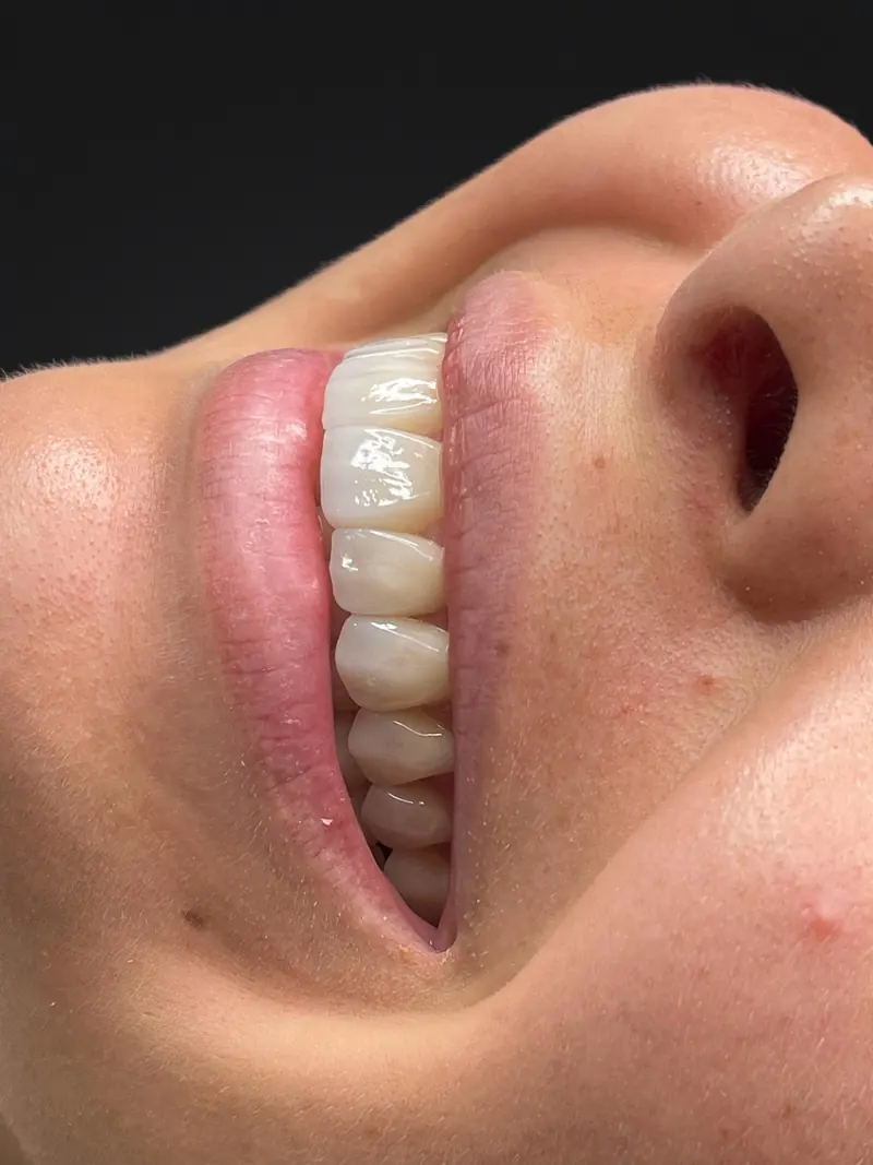 Perfil de una sonrisa con diseño de sonrisa en lentes cerámicos