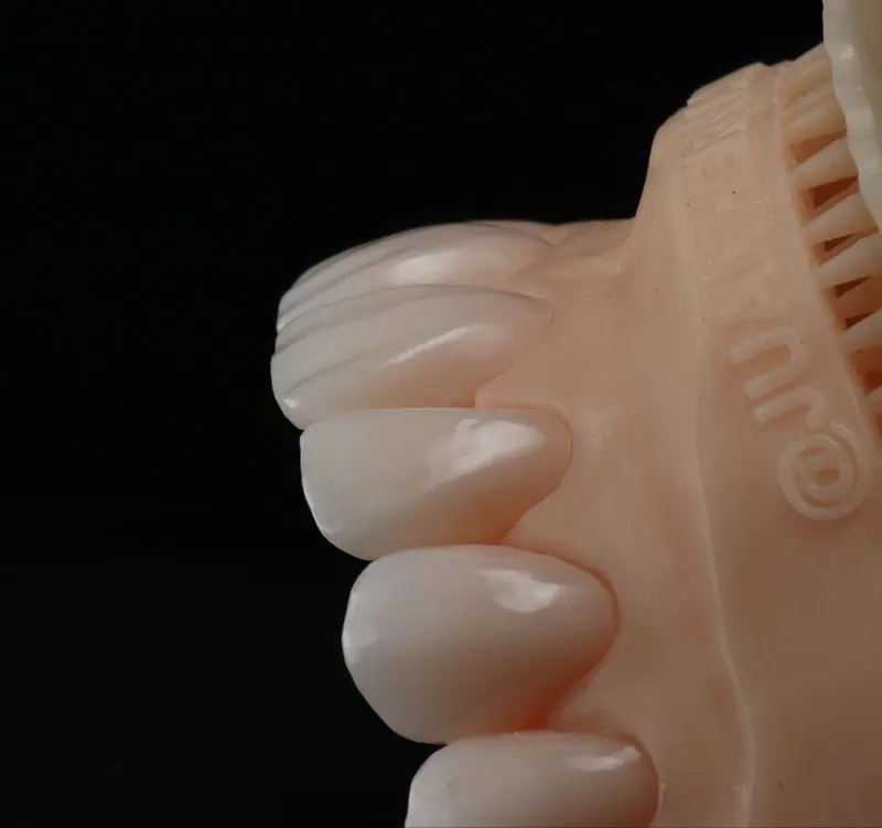 Modelo de laboratorio dental con lentes cerámicos elaborados por un mecánico dental
