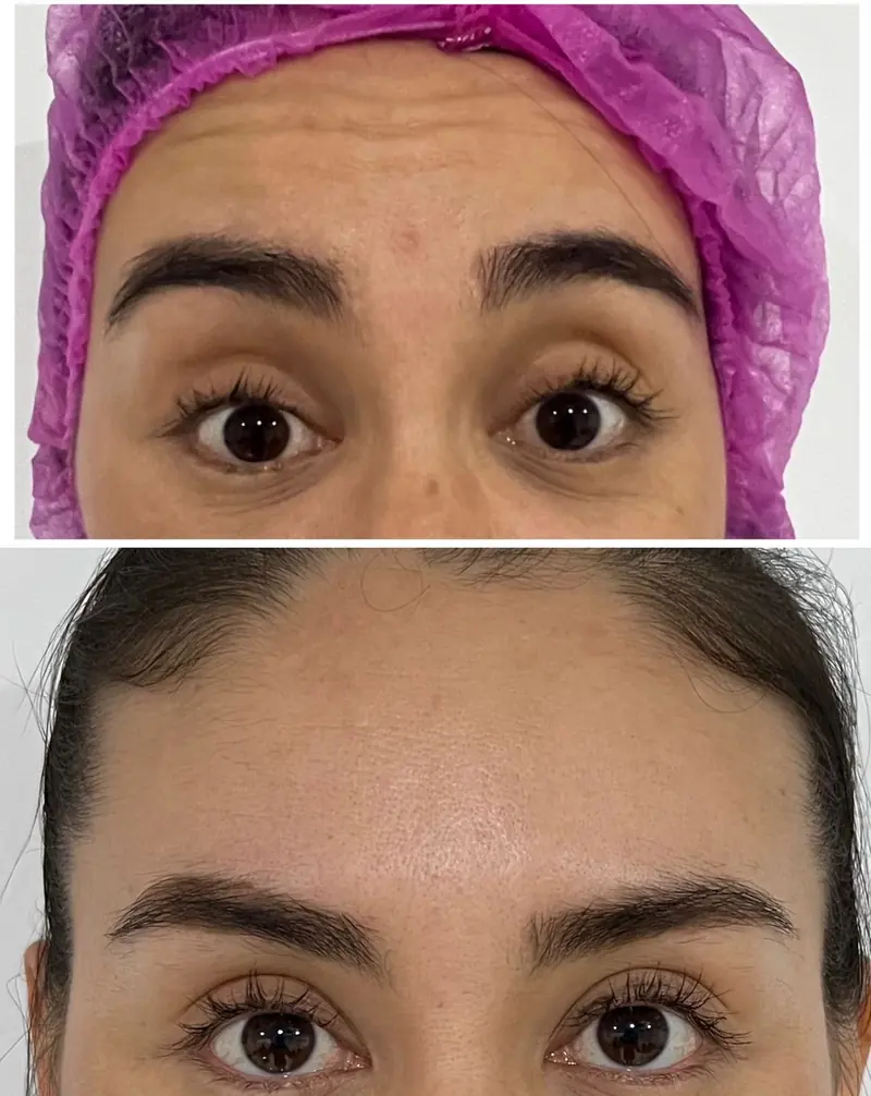 Antes y después de un tratamiento con neurotoxinas para suavizar las líneas de la frente