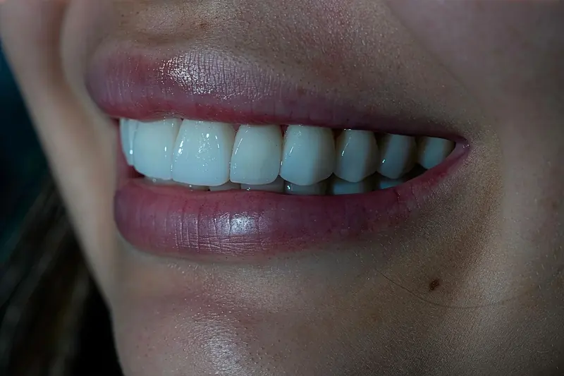 Sonrisa blanca y natural después de un blanqueamiento dental
