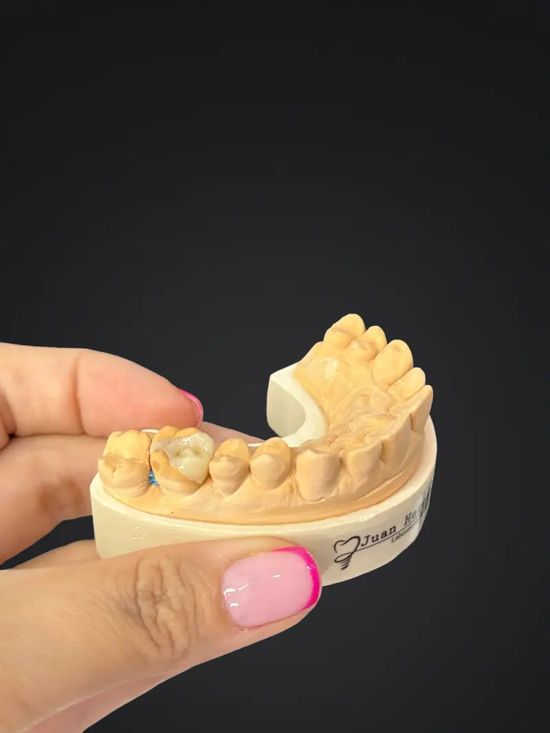 Modelo dental para planificar una rehabilitación oral con coronas y puentes